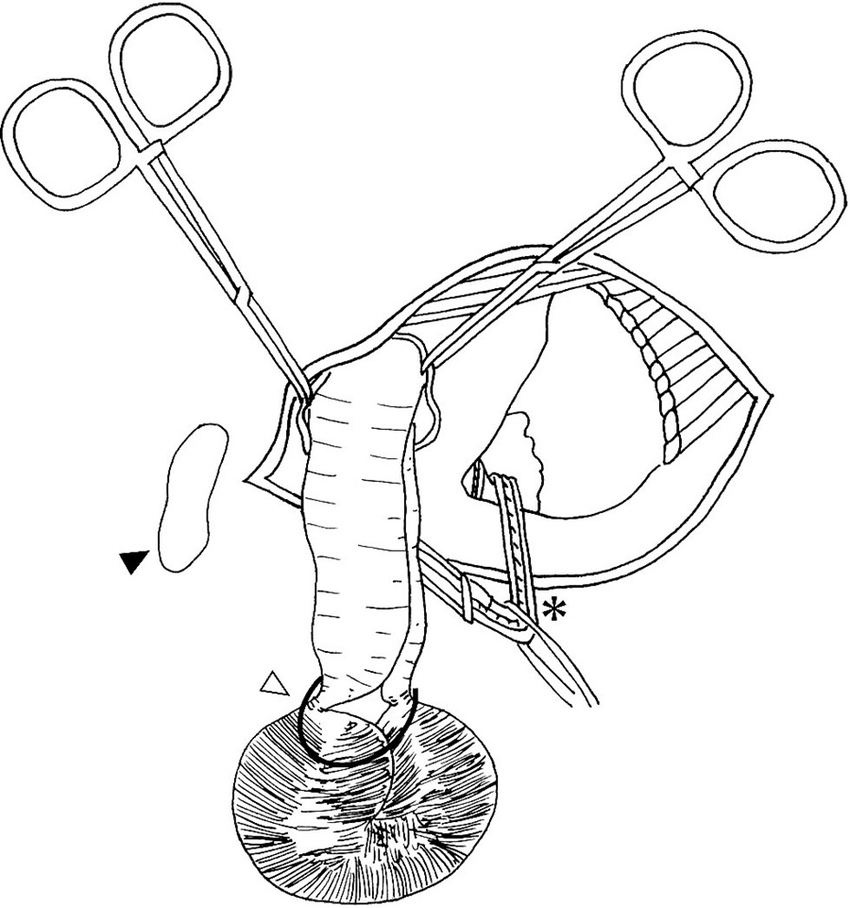 850x908 schematic drawing of the operation after incision of the hernial - Small Intestine Drawing
