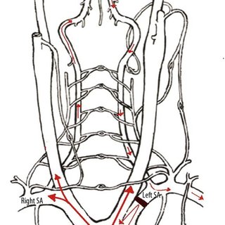 320x320 schematic drawing showing a left sided subclavian steal syndrome - Steal Drawing