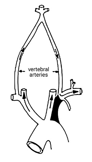 300x526 subclavian steal syndrome - Steal Drawing