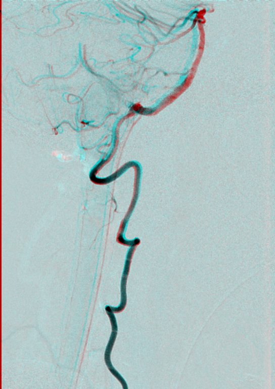 544x768 Stereo Angiography An Art Collection - Stereo Drawing