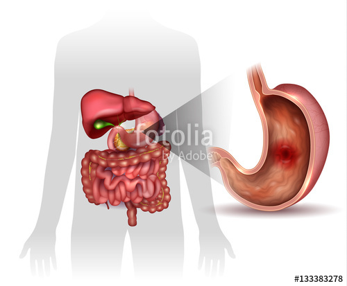 500x413 stomach ulcer, interanal organs anatomy colorful drawing stock - Stomach Drawing