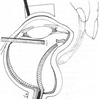 320x320 drawing of internal searching using endo illu mination - Surgeon Drawing