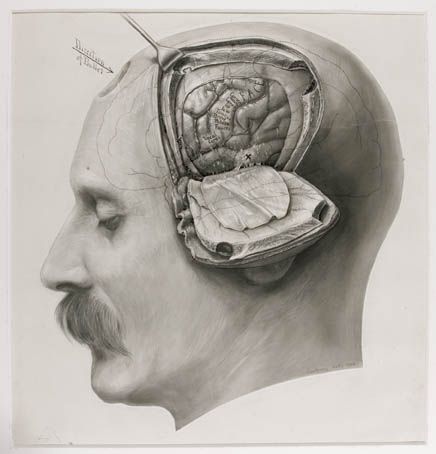 436x454 drawing of the brain during an operation, harvey cushing - Surgeon Drawing