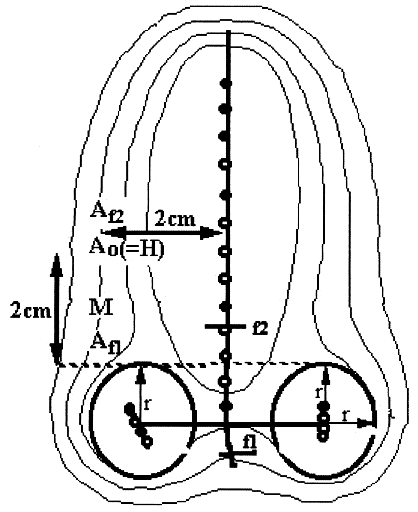 850x1041 An Illustration Of Geometry Relevant For Intracavitary Dosimetry - Tandem Drawing