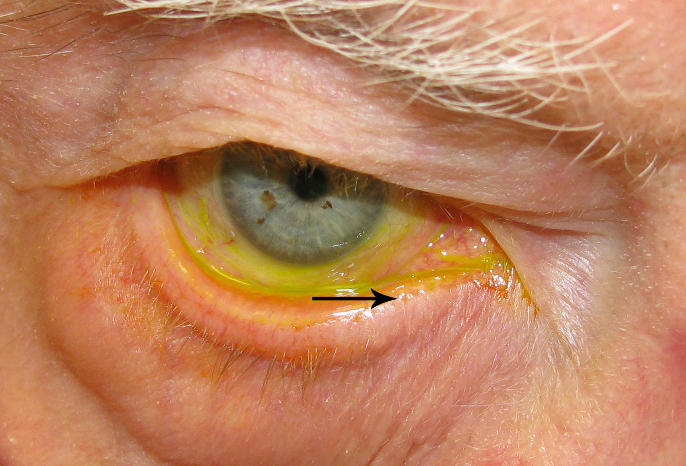 1348x916 tearing the problem could be in the lower lids joseph walrath, md - Teary Eye Drawing