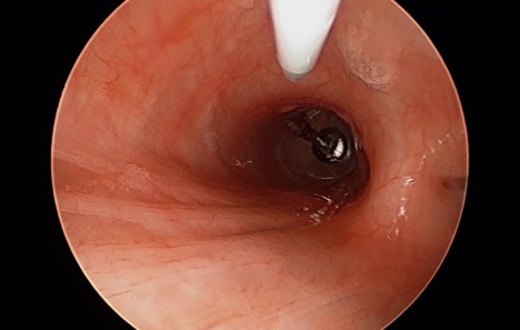 468x297 Thumbtack In Bronchus Be Smart, Don't Choke - Thumbtack Drawing