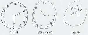 300x119 Montreal Cognitive Assessment - Time Clock Drawing