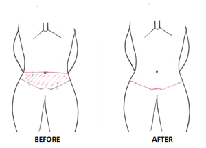 300x216 Tummy Tuck - Tummy Drawing