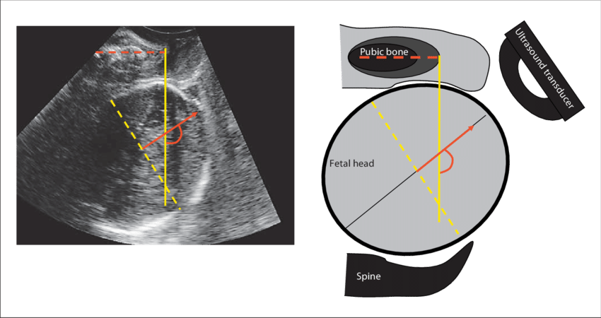 850x450 ultrasound image and drawing to demonstrate the fetal head - Ultrasound Drawing