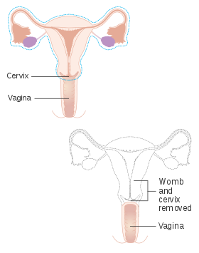 280x355 hysterectomy - Uterus Drawing