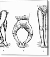 163x186 drawing of rickets - Vitamin Drawing