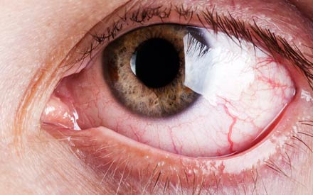 440x275 causes of bloodshot eyes and how you can treat them reader's digest - Watery Eyes Drawing