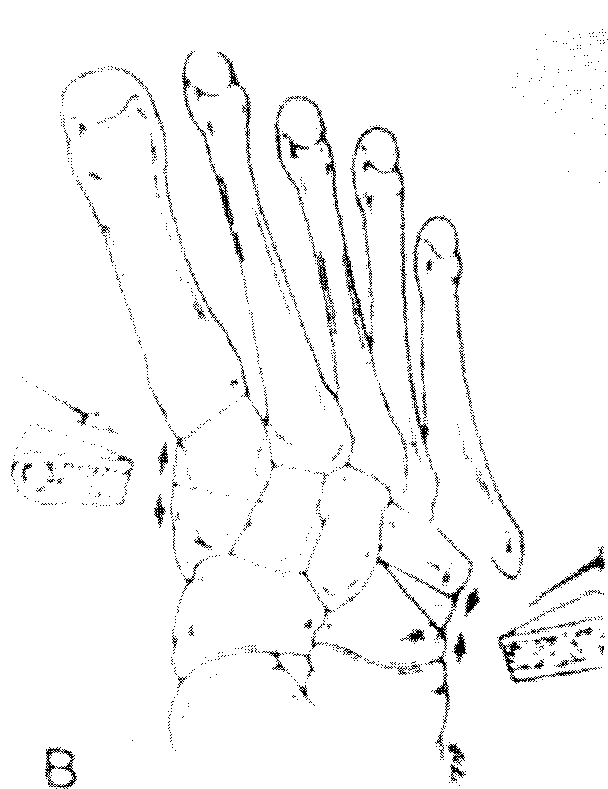 608x789 drawing of the foot shows the wedge removed from the cuboid - Wedge Drawing