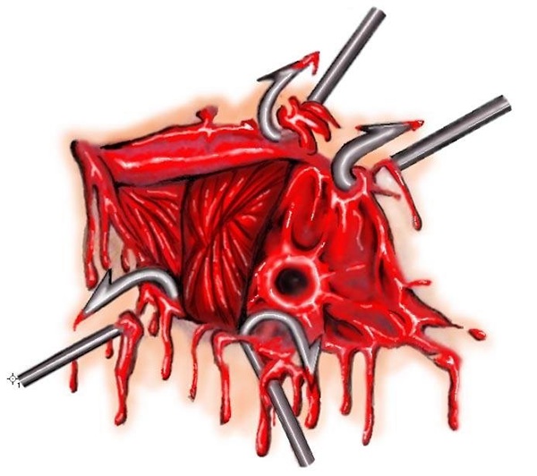 600x532 digital drawing, halloween wound on pantone canvas gallery - Wound Drawing