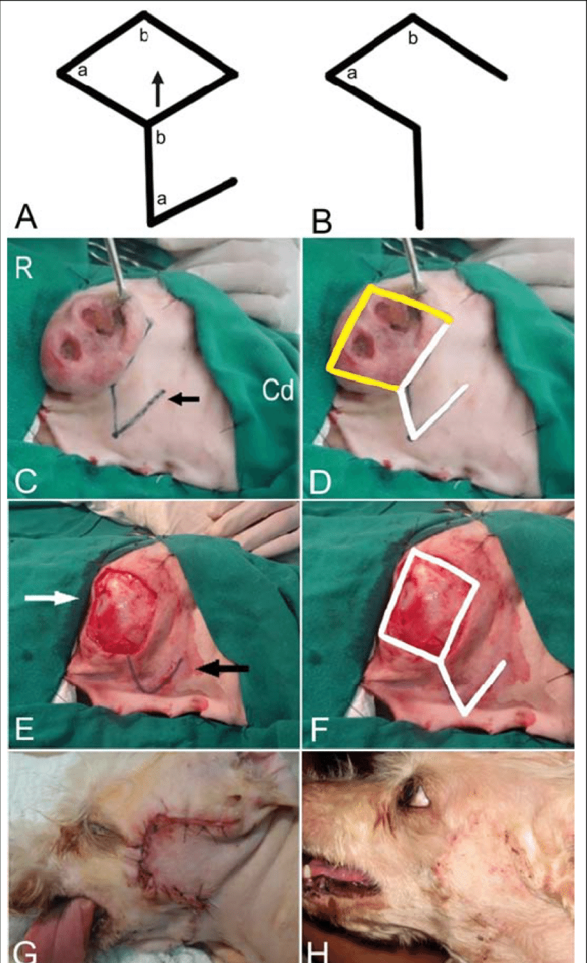 850x1395 drawing representing the rhomboid flap - Wound Drawing