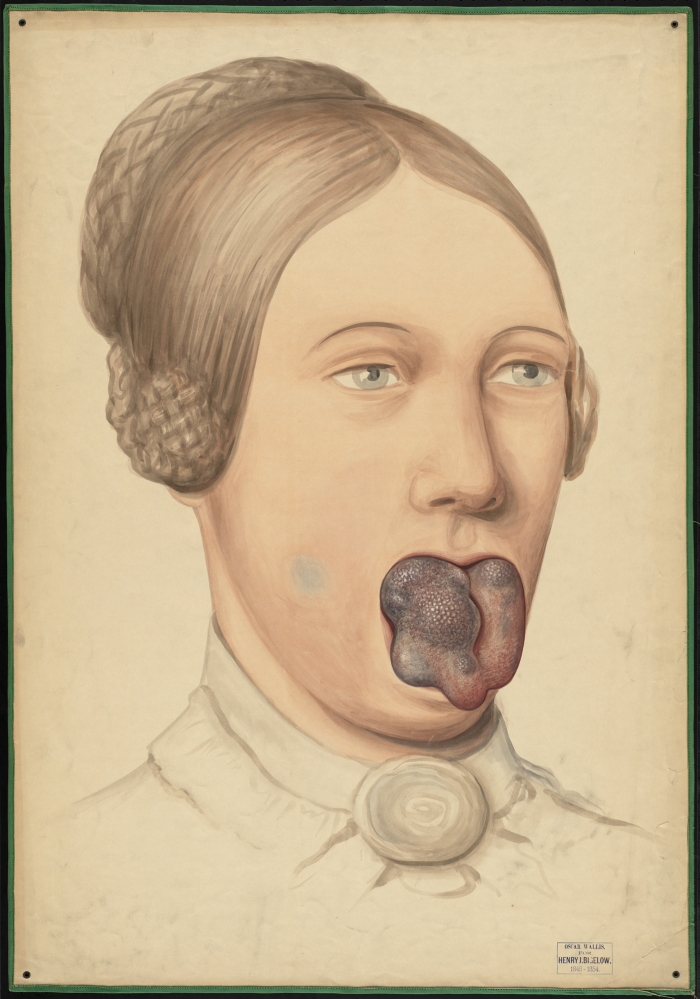 700x999 Teaching Watercolor Of Tongue Neoplasms Onview Digital - History Of Watercolor
