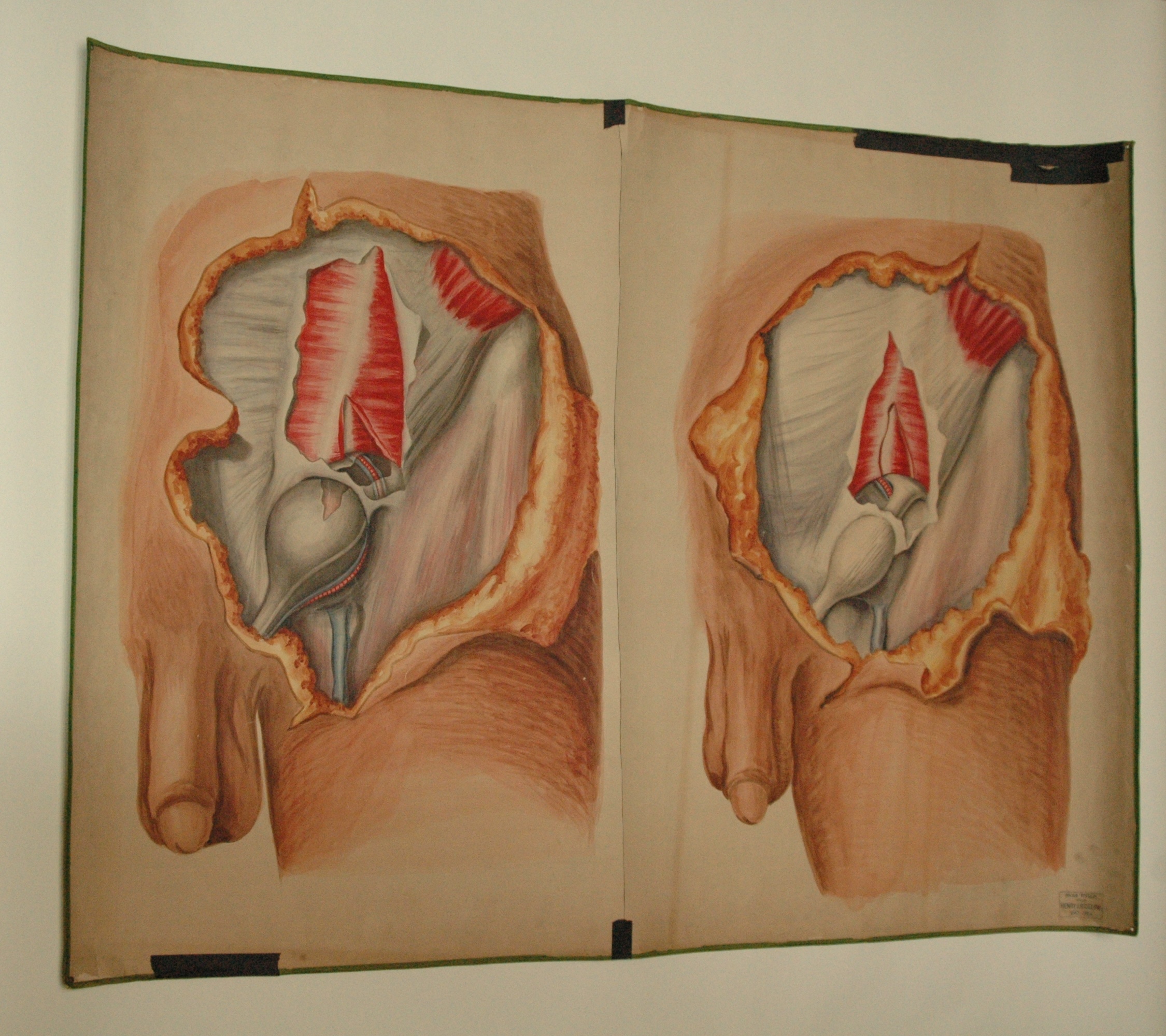 2250x2000 Teaching Watercolor Of Male With Inguinal Hernia, After Richard - Watercolor Human Body