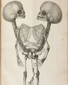 240x300 Vintage Conjoined Twin Skeleton Anatomy Medical Chart Painting - Anatomical Painting