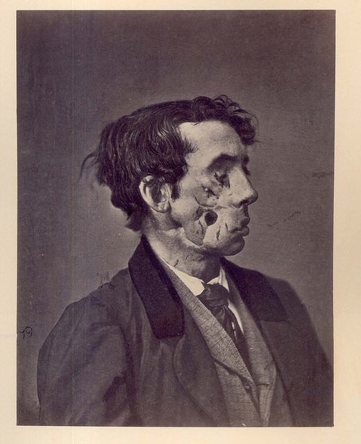 520x640 Walt Whitman's Battles Of Chancellorsville Horrific Wounds, Night - Battle Of Chancellorsville Painting