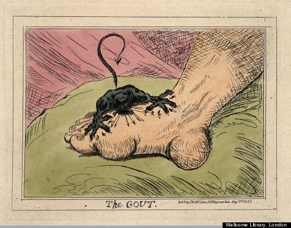 570x446 Artists' Caricatures Show The Macabre History Of Medicine Huffpost - Gout Painting