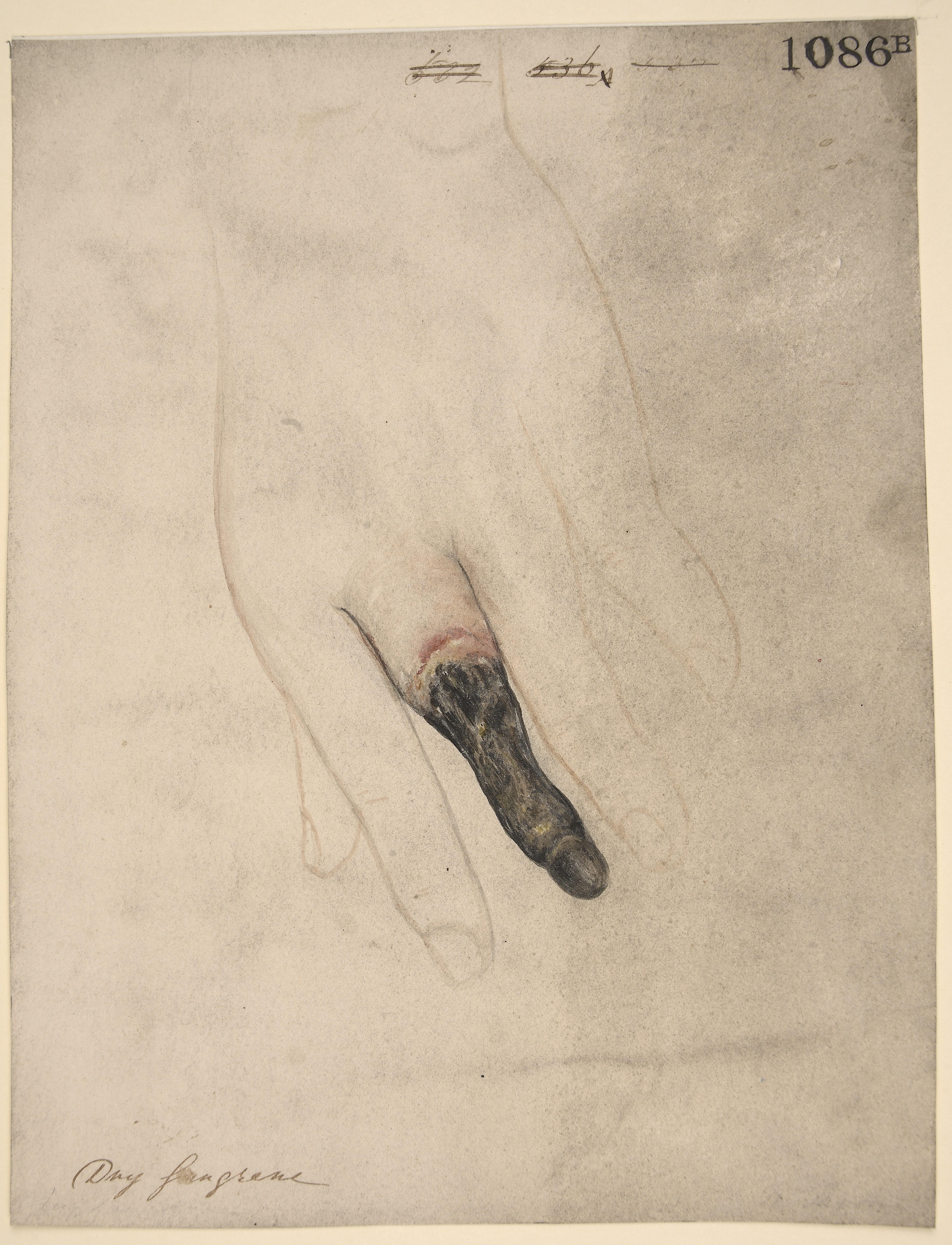 4624x6044 Filedry Gangrene Of The Middle Finger Wellcome L0062215.jpg - Middle Finger Painting