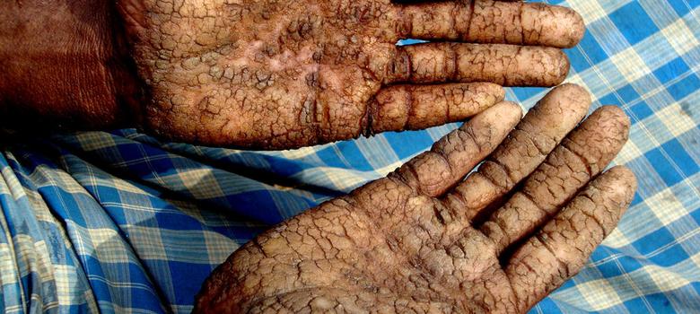 780x350 How Painting Hand Pumps Red Could Save Thousands From Poisoning - Painting Poisoning