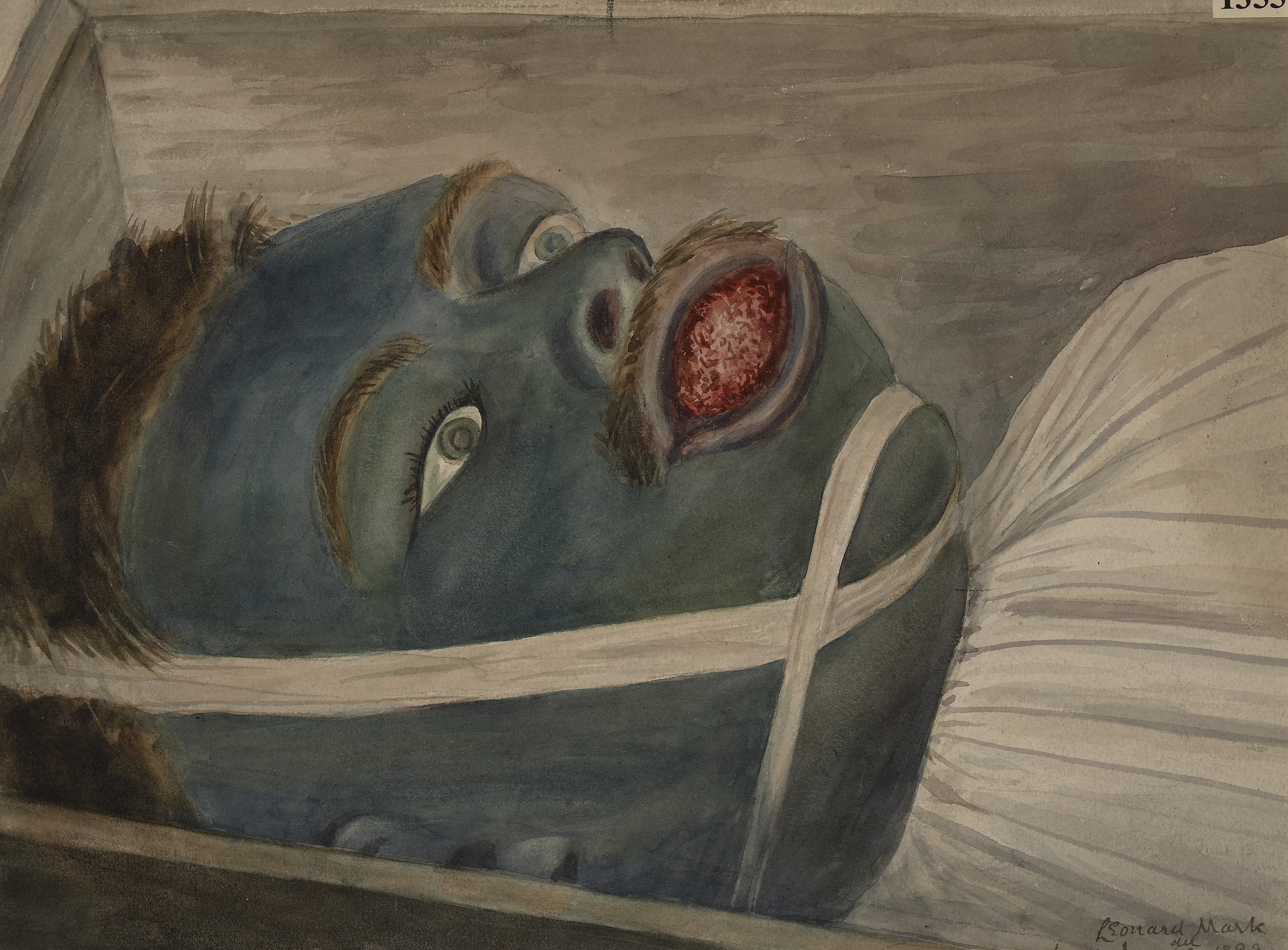5144x3796 Fileface Of A Man Showing Post Mortem Discolouration Wellcome - Post Mortem Painting