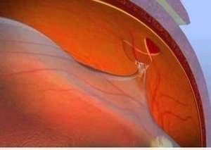 300x213 Intervento Distacco Di Retina - Retinal Painting