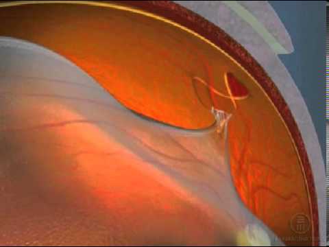 480x360 Retinal Tear - Retinal Painting