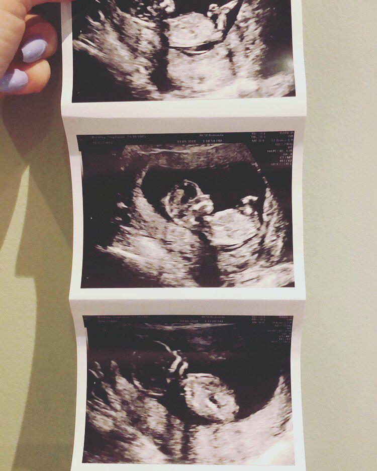 750x937 Ultrasound Pictures Printout Into A Real Work Of Art Read All - Ultrasound Painting