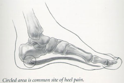 500x335 Heel Pain - Ankle Sketch