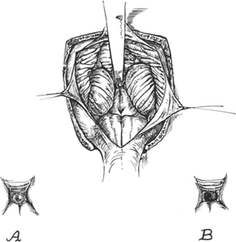 999x1024 Membranous Occlusion Of The Aqueduct Of Sylvius Journal Of - Aqueduct Sketch
