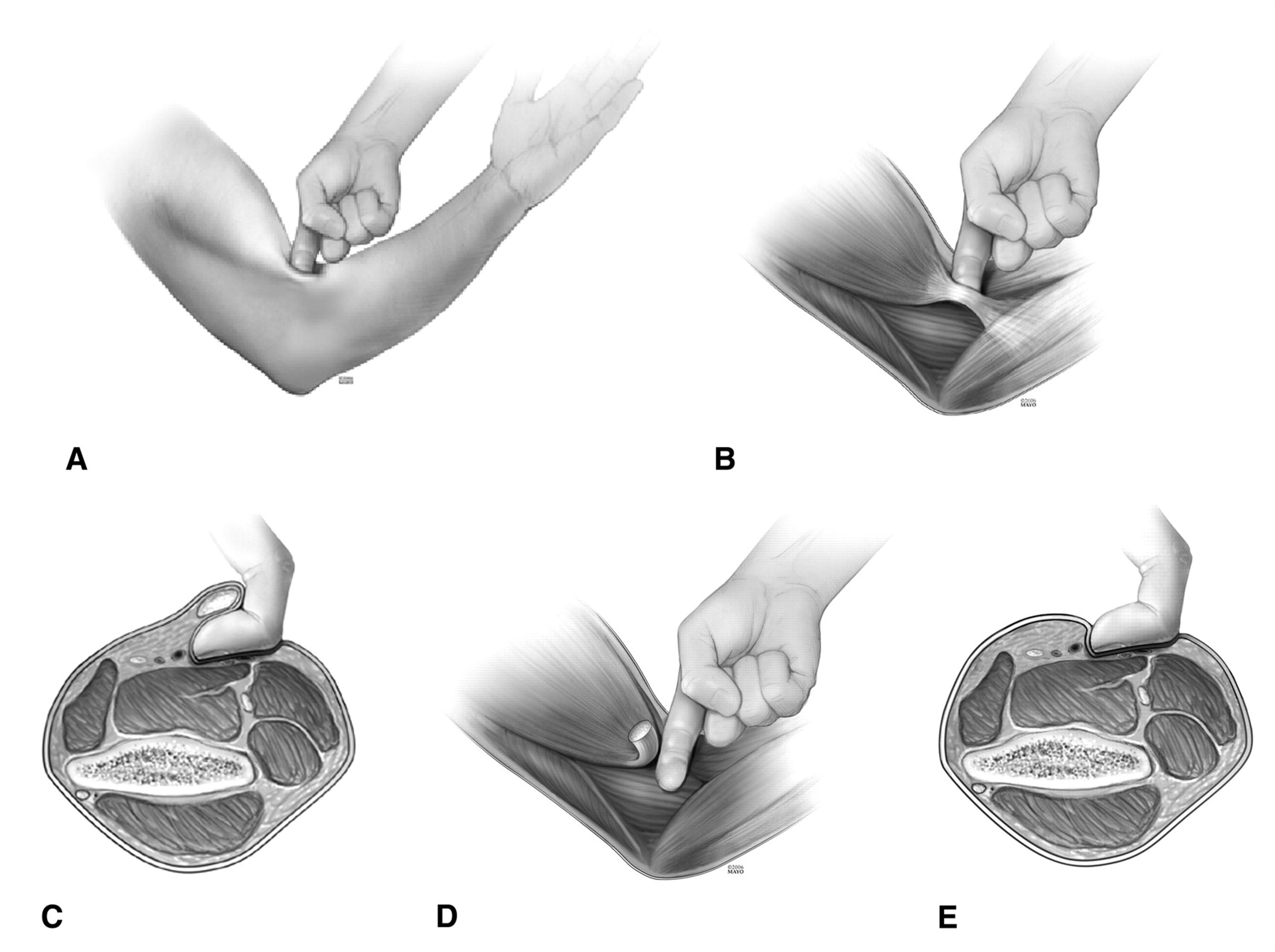 2676x2000 Distal Biceps Avulsion - Bicep Sketch