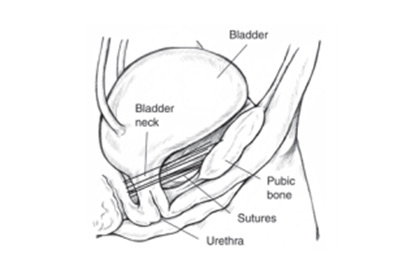 400x268 Surgery - Bladder Sketch