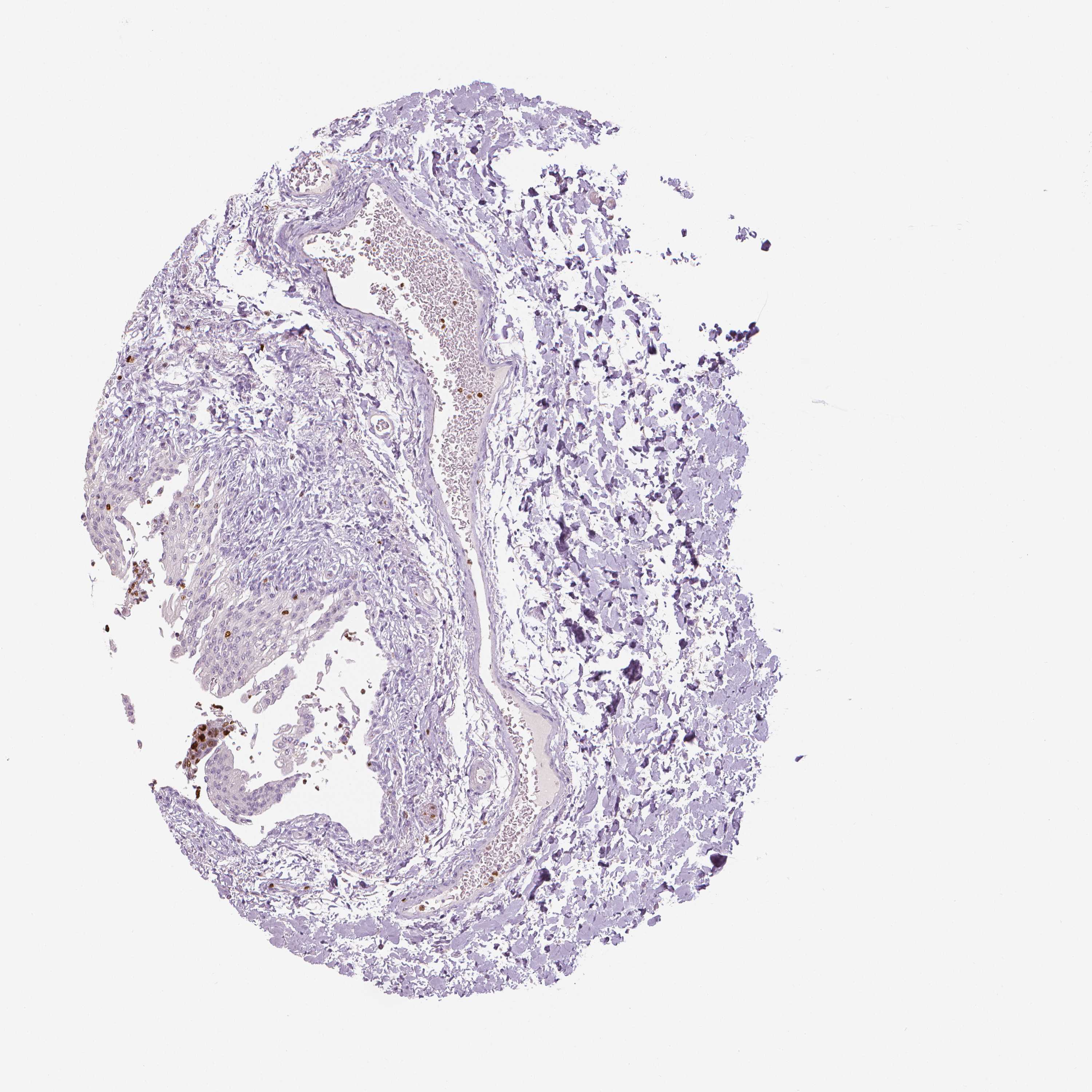 3000x3000 Tissue Expression Of Mki67 - Bladder Sketch