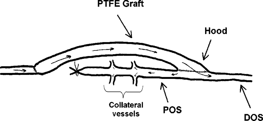 850x391 Sketch Showing The Surgical Bypass Configuration In Which Blood - Blood Sketch