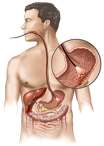 337x475 Gastric Cancer Sketch - Cancer Sketch