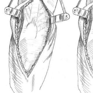 320x320 Pdf) Newcastle Approach To The Elbow, A Cadaveric Study - Elbow Sketch