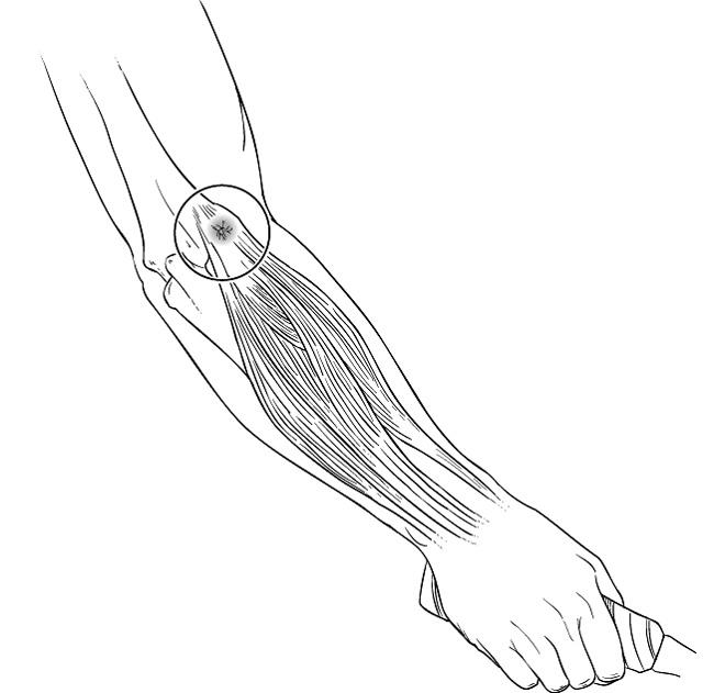 650x631 Tennis Elbow (Lateral Epicondylitis) - Elbow Sketch