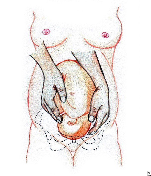 608x709 Hands Position To Palpate For Fetal Presentation Download - Fetal Position Sketch