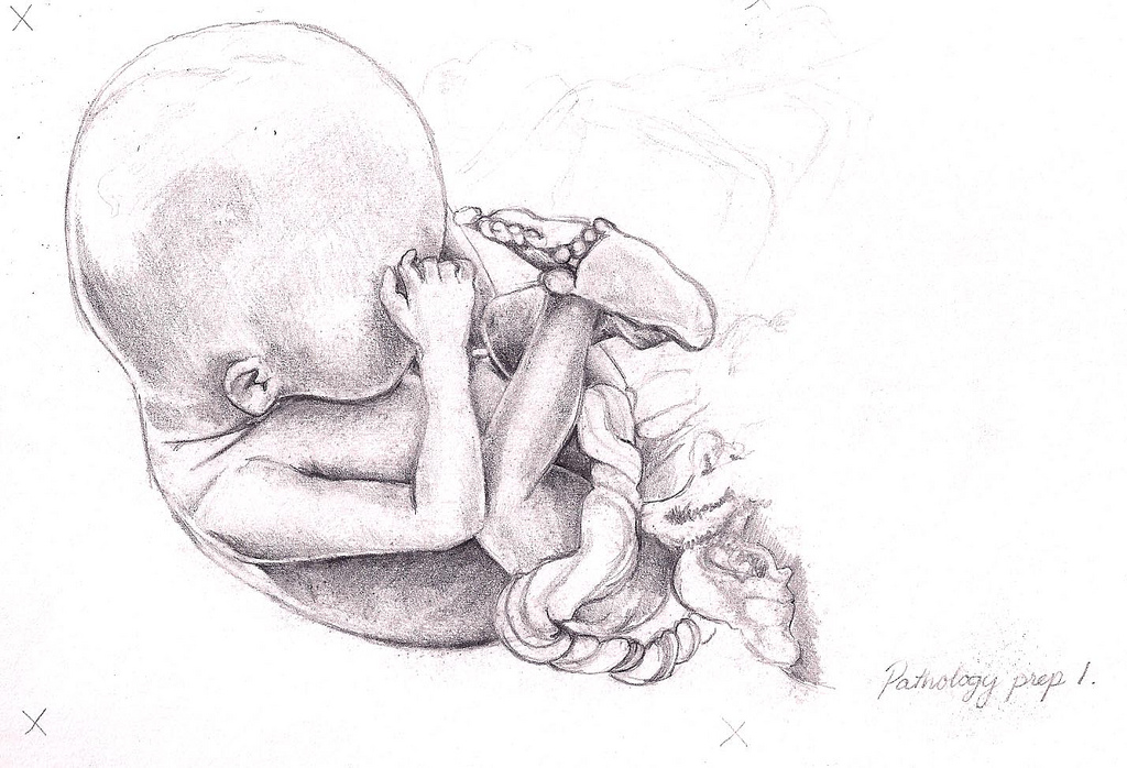 1024x698 Fetus Sketch X Pencil On Paper Description From - Fetus Sketch