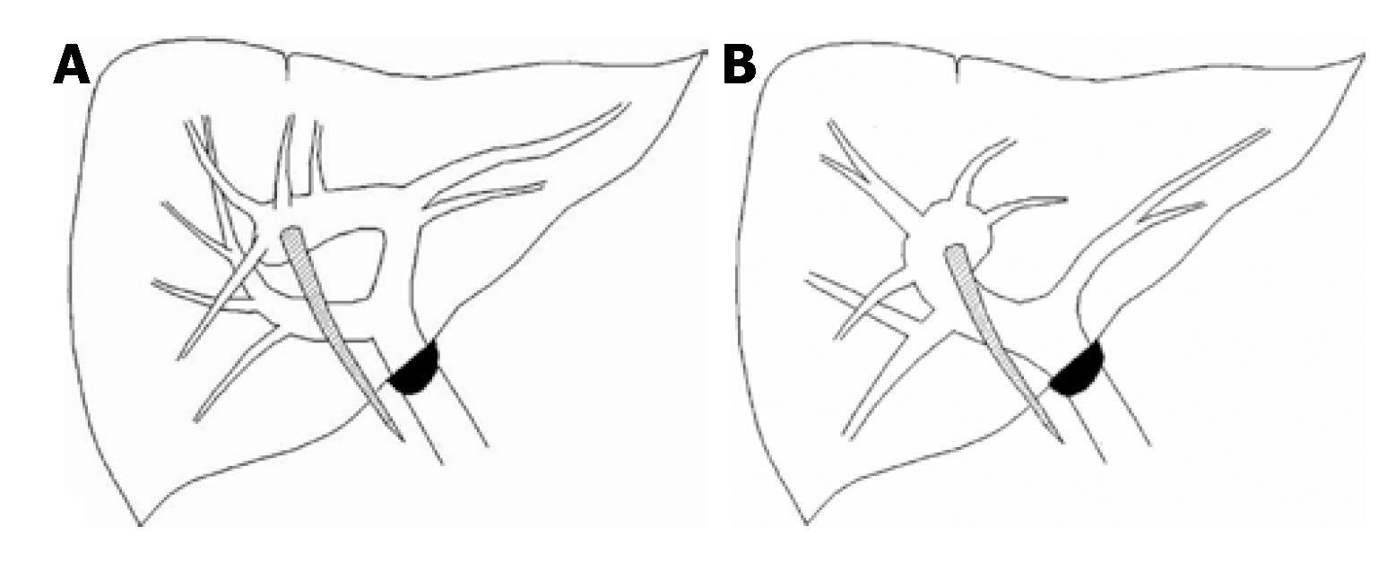 1547x626 Left Sided Gallbladder Its Clinical Significance And Imaging - Gallbladder Sketch