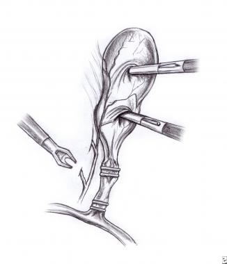 326x380 Pediatric Cholecystitis Background, Pathophysiology, Etiology - Gallbladder Sketch