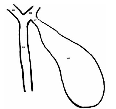 375x351 Variaciones De Los Ductos Biliares Y - Gallbladder Sketch