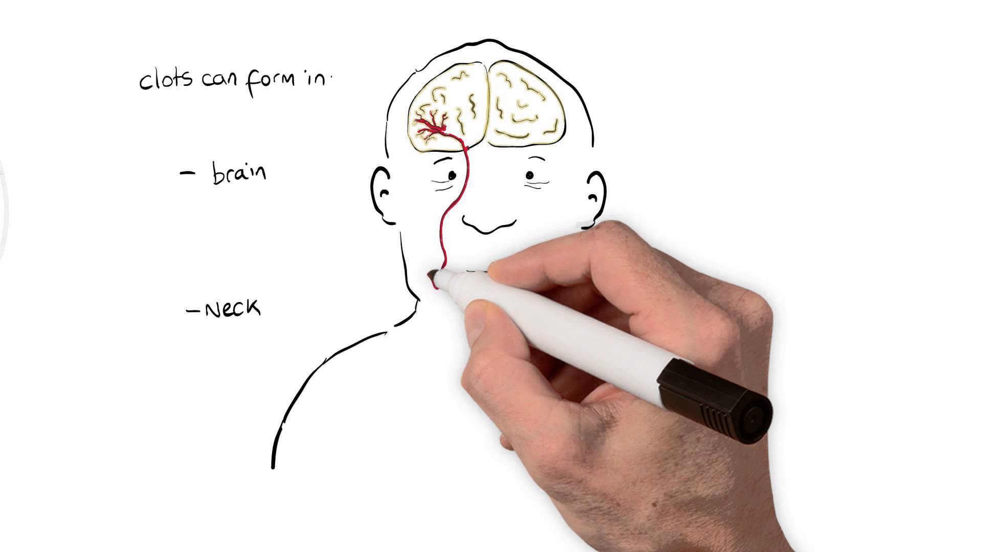 1920x1080 What Is A Stroke Animated Explanation Video - Health Sketch