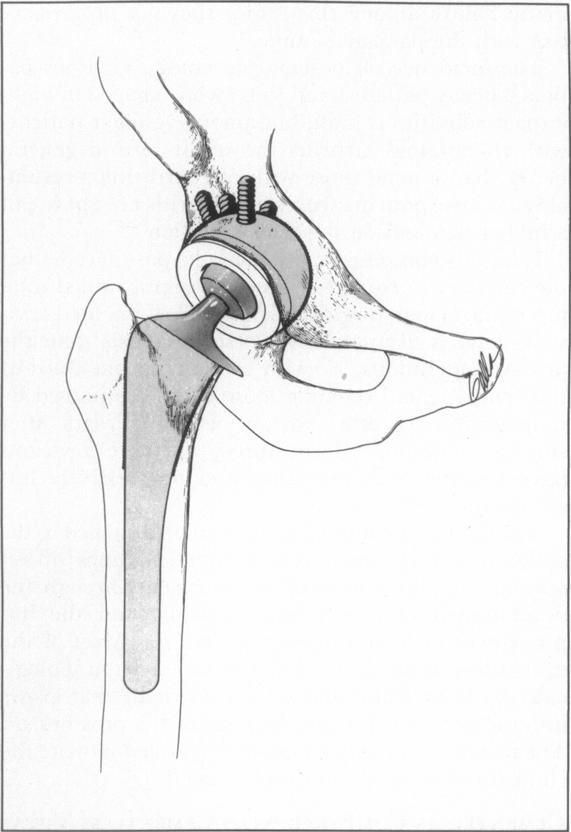 800x1166 Total Hip And Total Knee Replacement Nejm - Hip Sketch