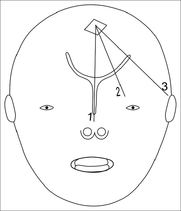 634x738 Sketch Of Infant Skull Showing The Sites Of Three Standard - Infant Sketch