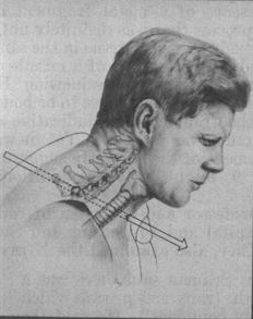 232x293 John F. Kennedy Autopsy - Jfk Sketch