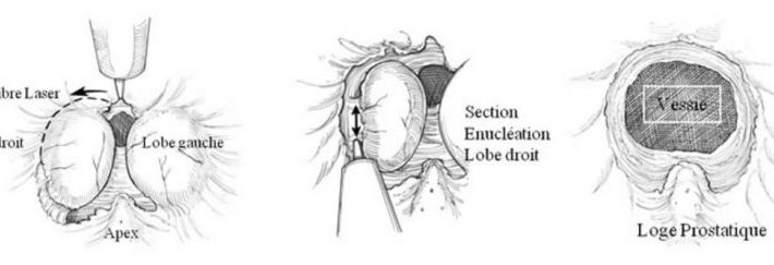 710x243 Laser - Laser Sketch
