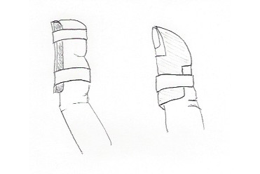 371x248 Mallet Finger Sport Med School - Mallet Sketch